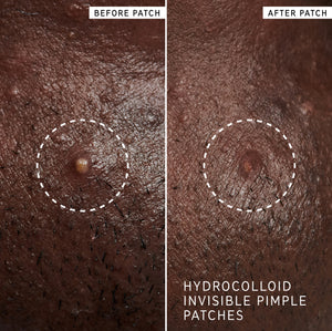 Before and after using Hydrocolloid Invisible Pimple patches