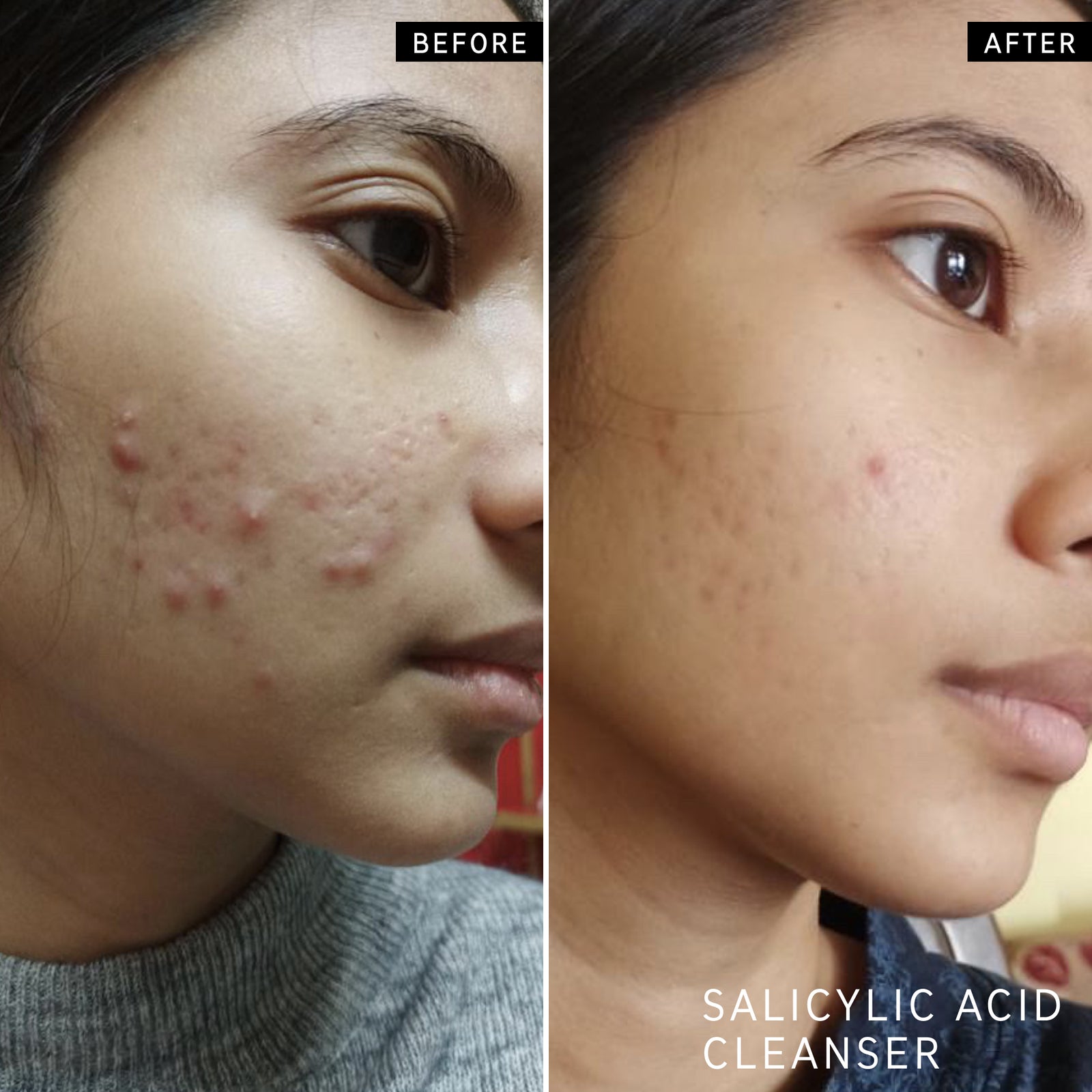 Before and after of customer using Salicylic Acid Cleanser