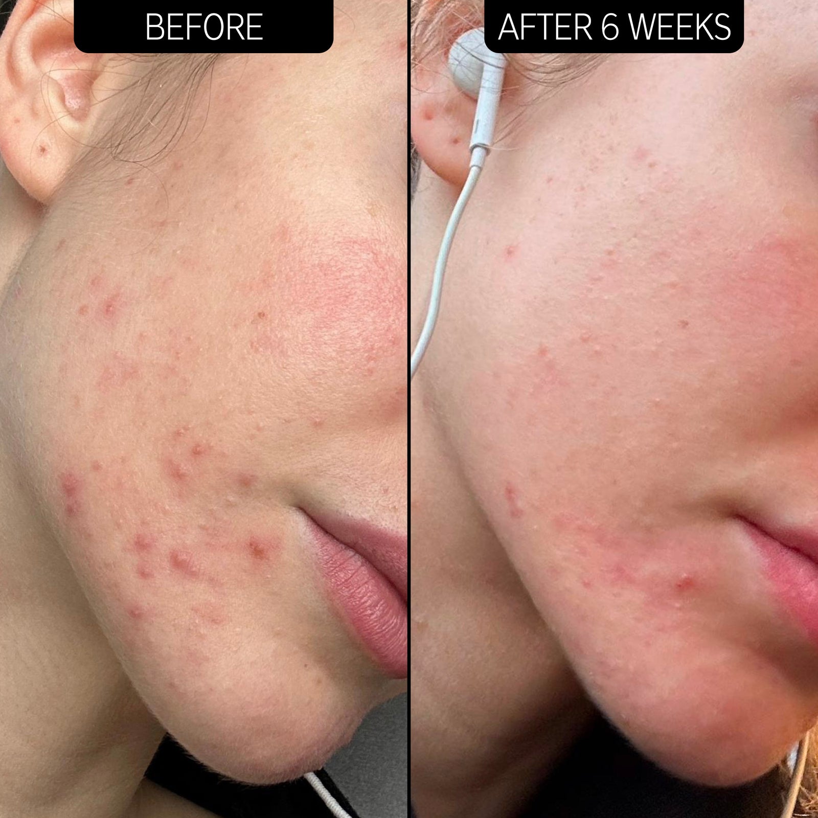 Before and after 6 week results displaying significant blemish reduction 
