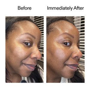 Before and after comparison of a woman's face with visible skin treatment.