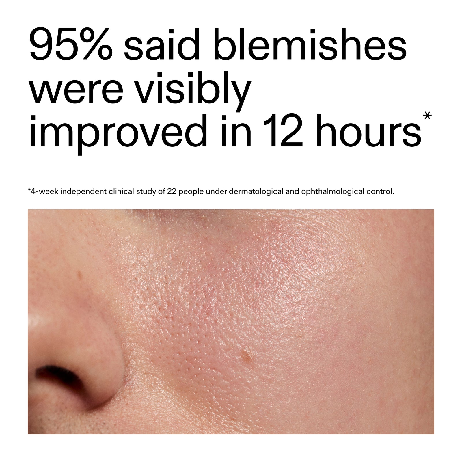 Advertisement showing a close-up of skin with blemishes and text about improvement in 12 hours after using Succinic Acid Treatment