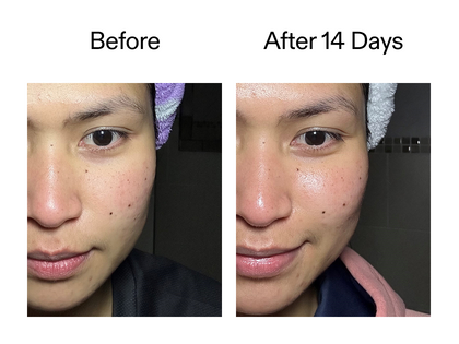 Before and after comparison of a person's face with visible skin improvement over 14 days.