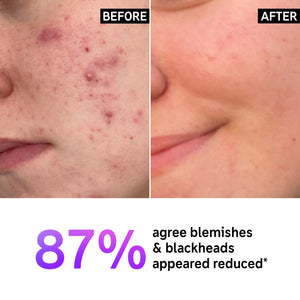 Before & after using Supersize Salicylic Acid Cleanser Duo showing visible results, text reads '87% agree blemishes and blackheads appeared reduced*'