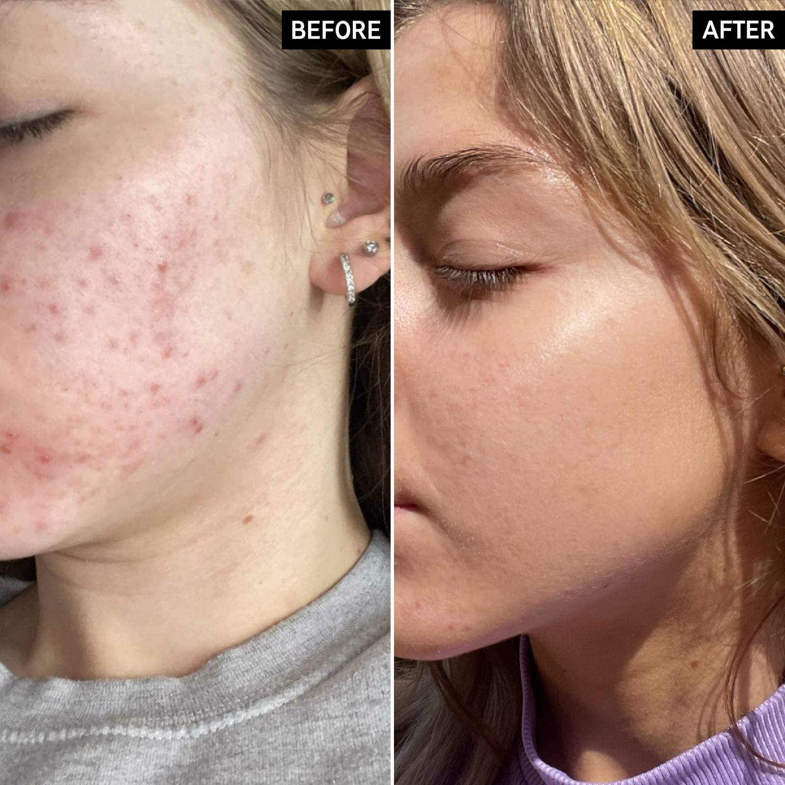 Before and after using Niacinamide Serum