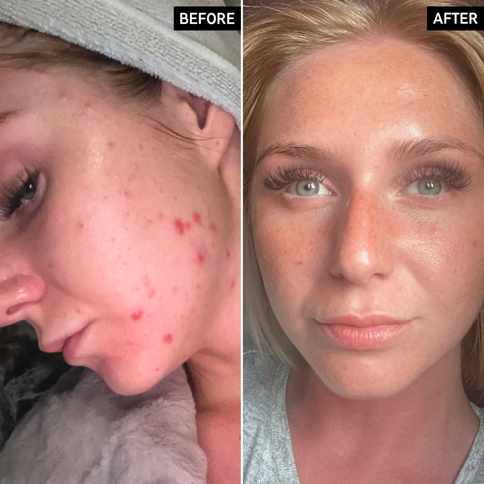 Before and after of Adelle from using the products in the Clearer Skin Cleanse Duo displaying positive results after a 3 month period