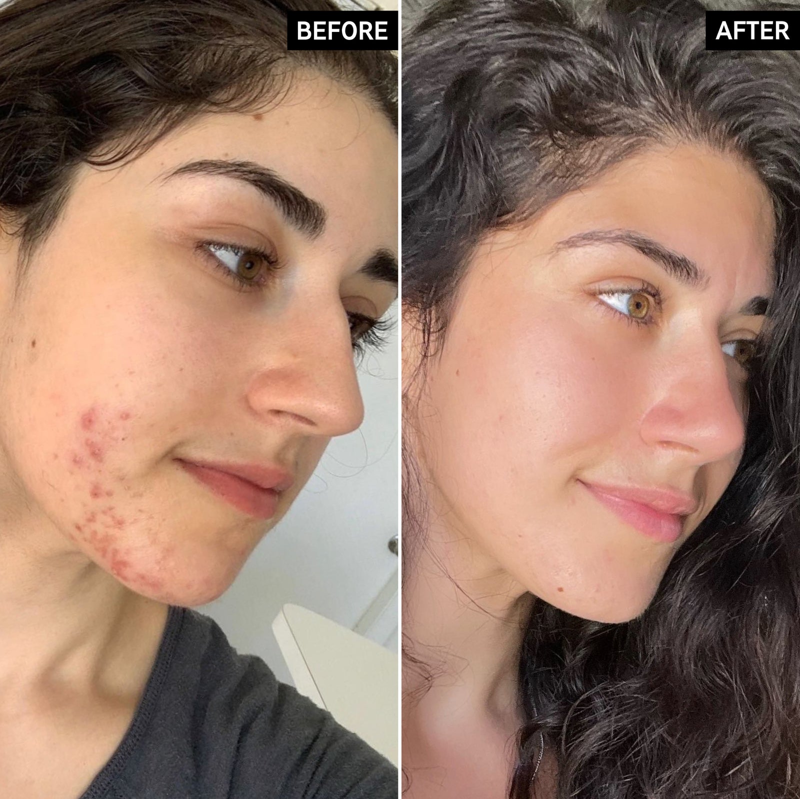 Before & After of customer using Succinic Acid Treatment in the Clearer Skin Routine