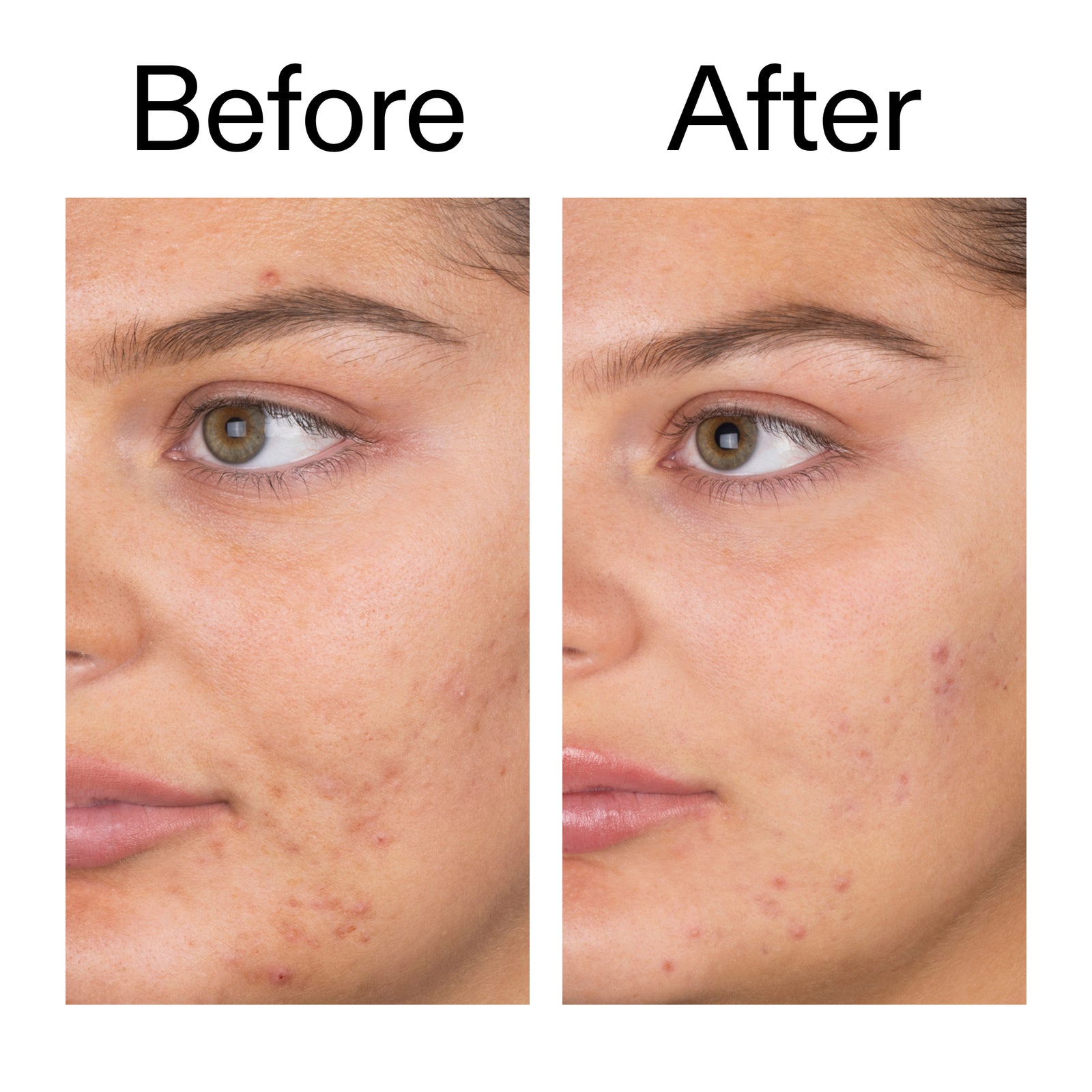 Before and after comparison of a person's face after using Salicylic Acid Cleanser