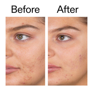 Before and after comparison of a person's face after using Salicylic Acid Cleanser