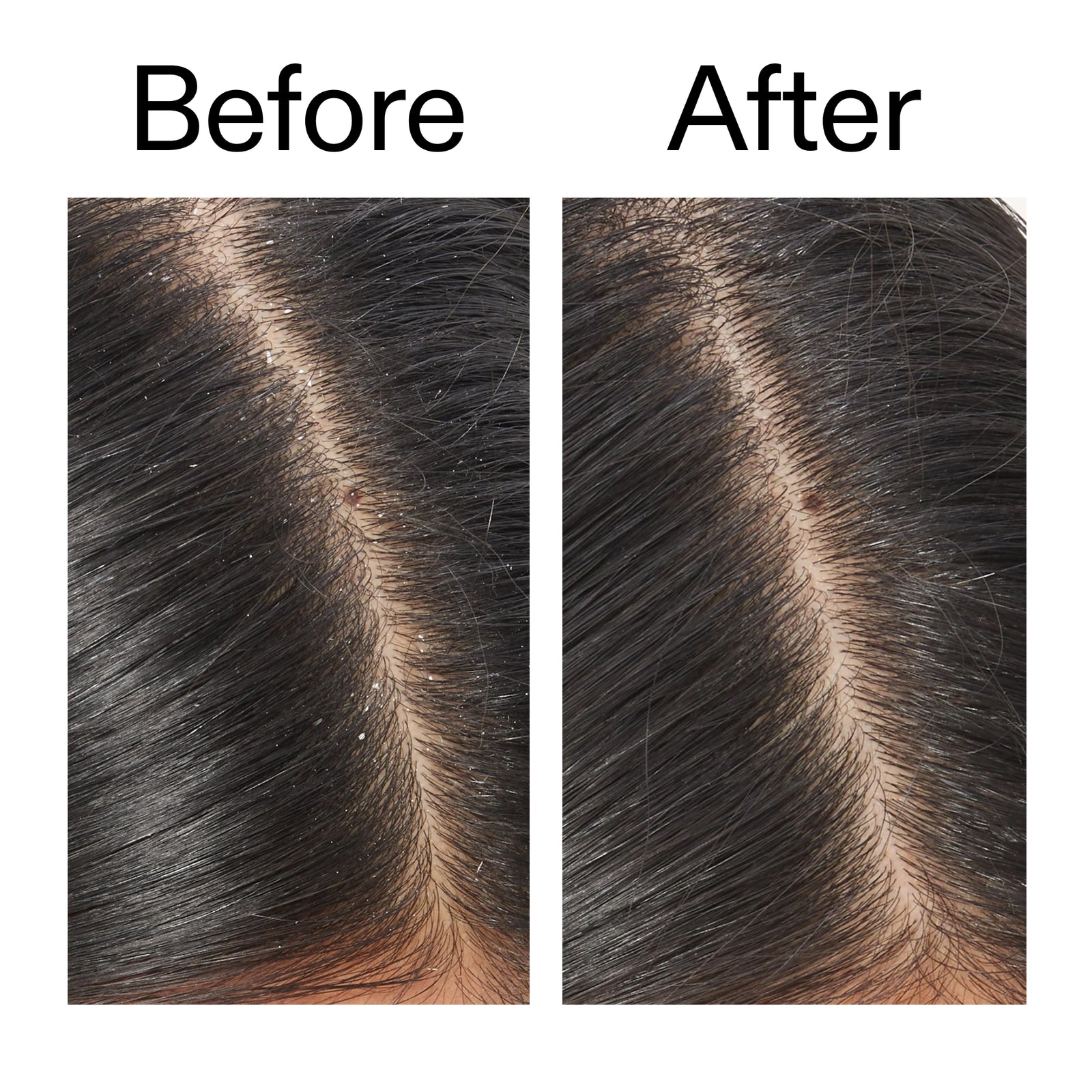 Before and after using Salicylic Acid Exfoliating Scalp Treatment