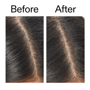 Before and after using Salicylic Acid Exfoliating Scalp Treatment