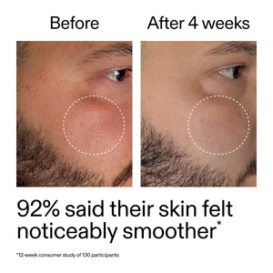 Before and after comparison of a man's skin with a visible improvement in texture.