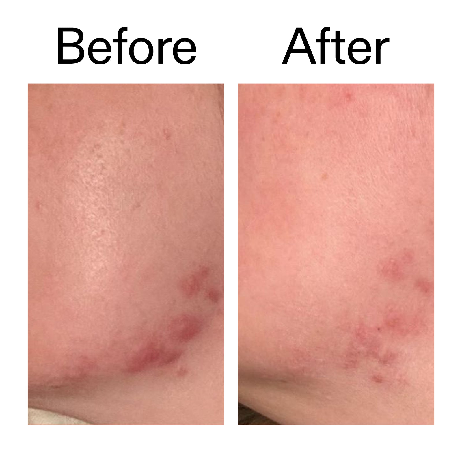 before and after using succinic for acne