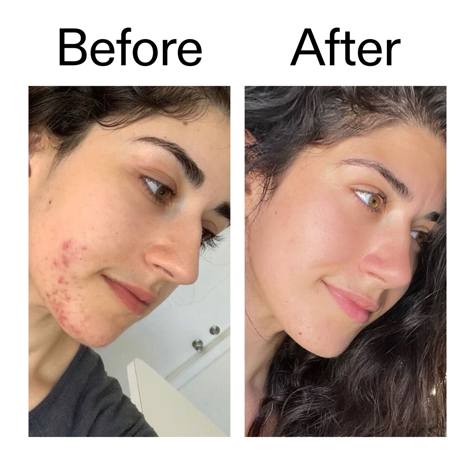 Before and after comparison of a person with acne on their face.