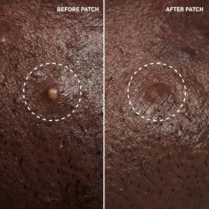 Before and after using Hydrocolloid Invisible Pimple Patches showing reduced blemish gunk