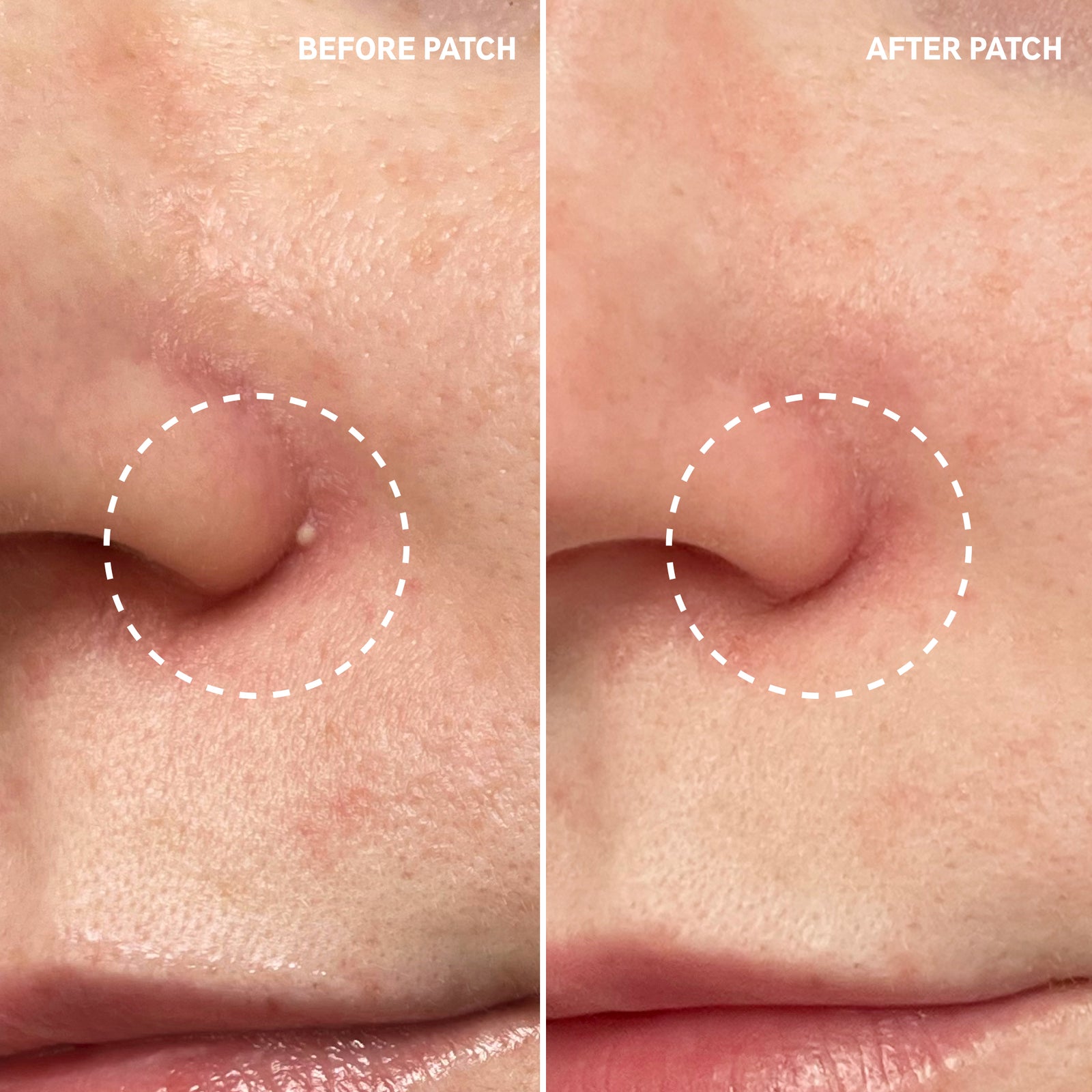 Hydrocolloid Spot & Pimple Patch | The INKEY List UK