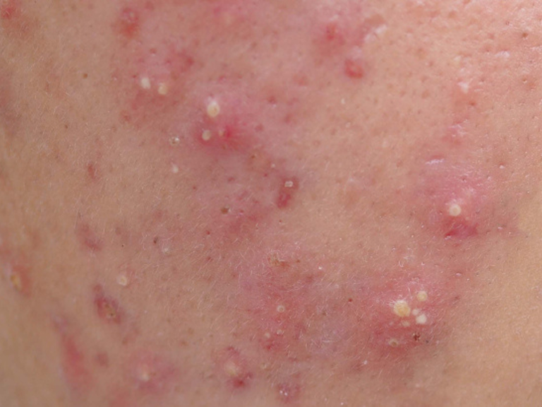 Close-up of skin with small red bumps and lesions