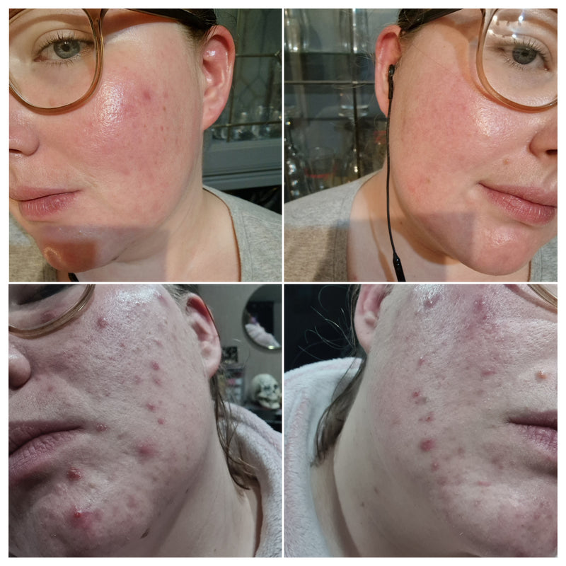 A before and after of Molly having used the Oat Cleansing Balm