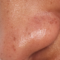 close up of blackheads