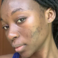 woman with acne scars