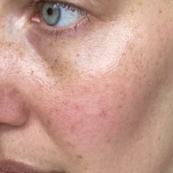 woman with hyperpigmentation