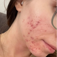 acne on someones cheek