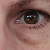 close of eye with dark circles and eye bags