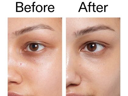 Before and after comparison of a person's eye area with visible improvement.