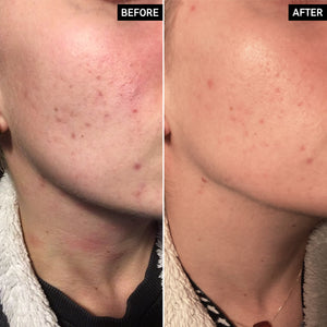 Before and After of customer using Apple Cider Vinegar Acid Peel