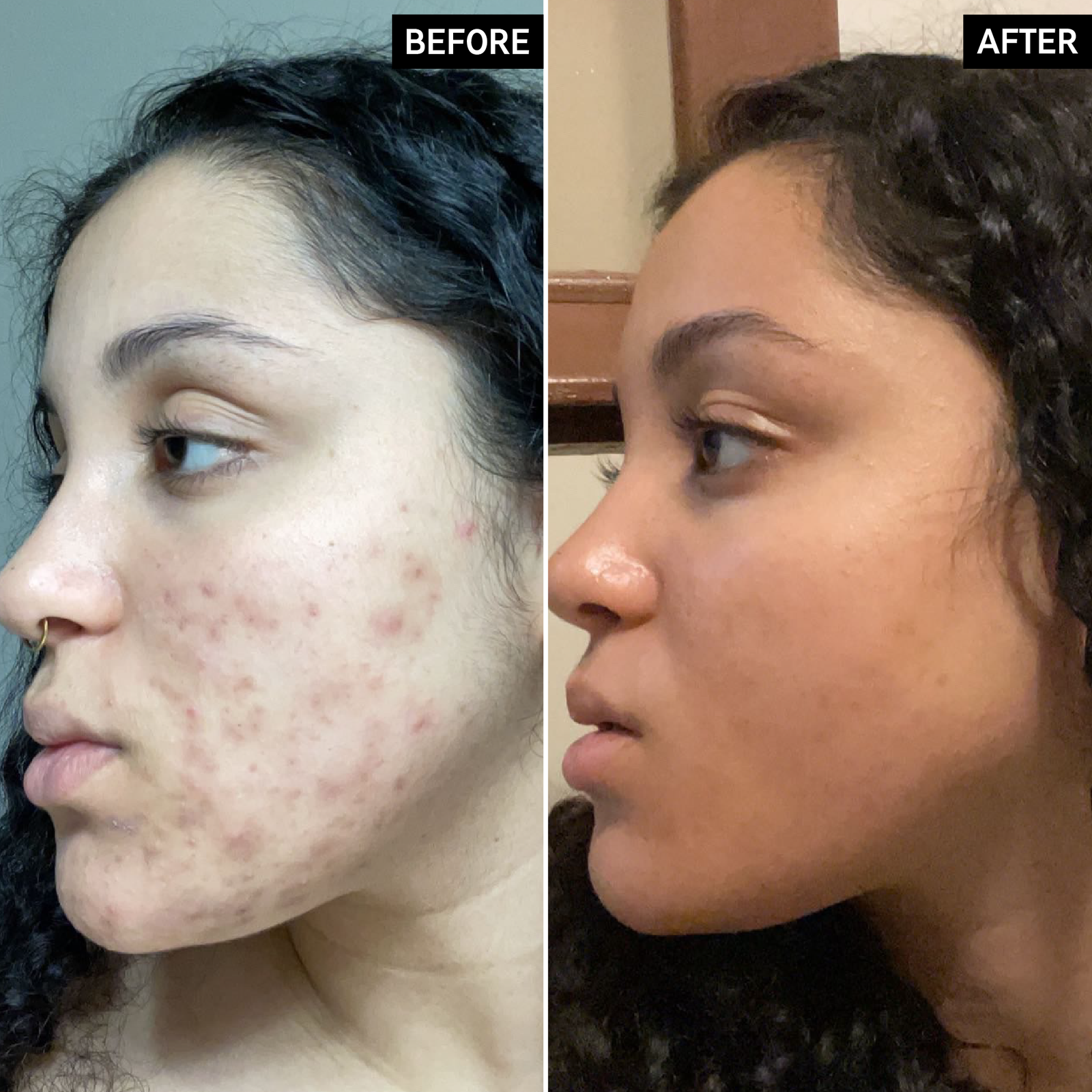 Before and After of customer using Vitamin C Serum