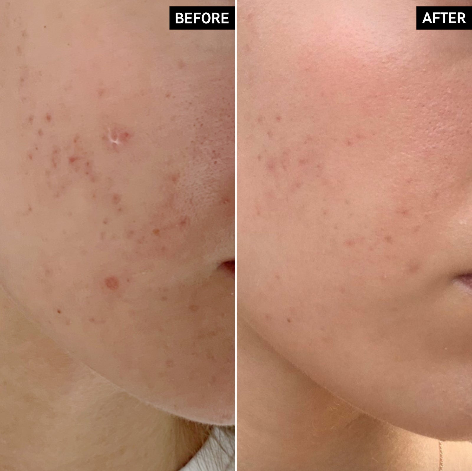 Before & After of customers using Mandelic Acid Treatment